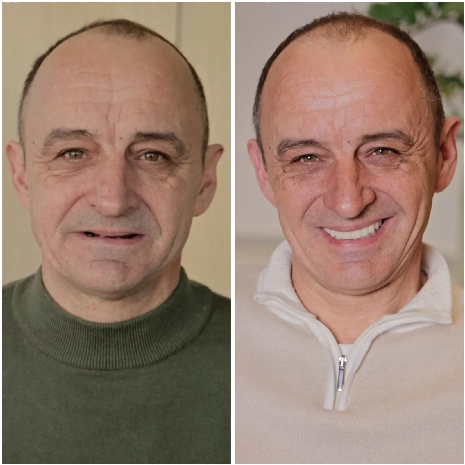 Відновлення усмішки у складних умовах